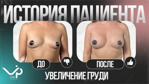 Выпуск 22 — участница проекта «Грудь для мам». История пациента Нины