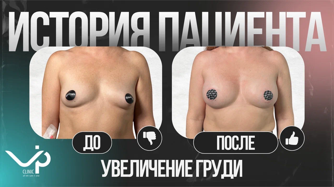 Выпуск 22 — участница проекта «Грудь для мам». История пациента Нины